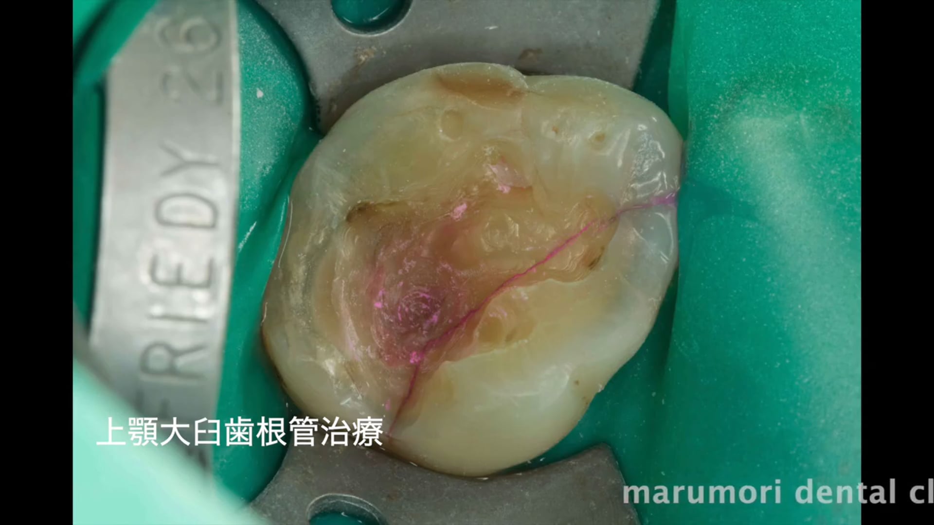 上顎大臼歯・根管治療