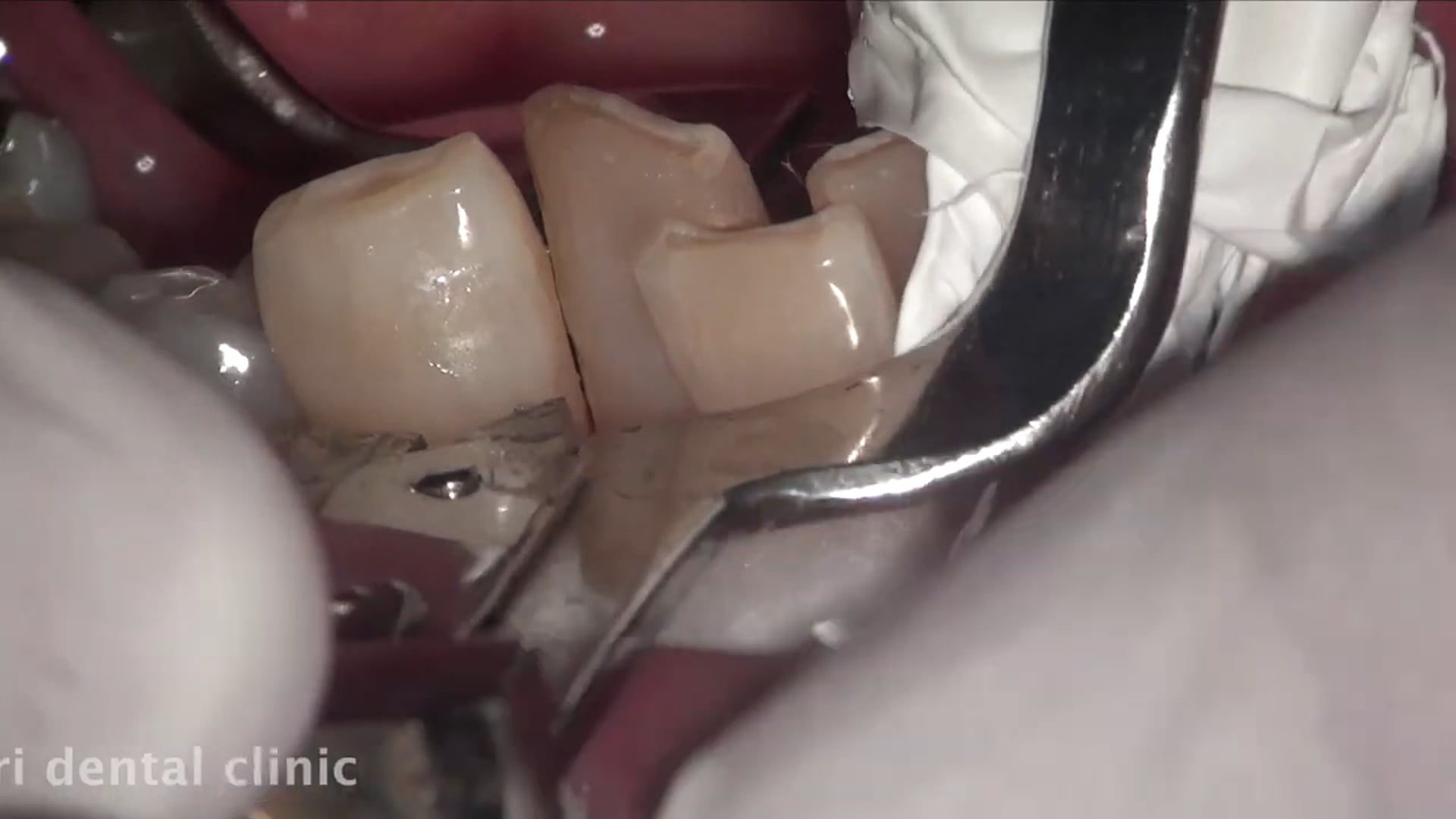 下顎前歯・レジン充填