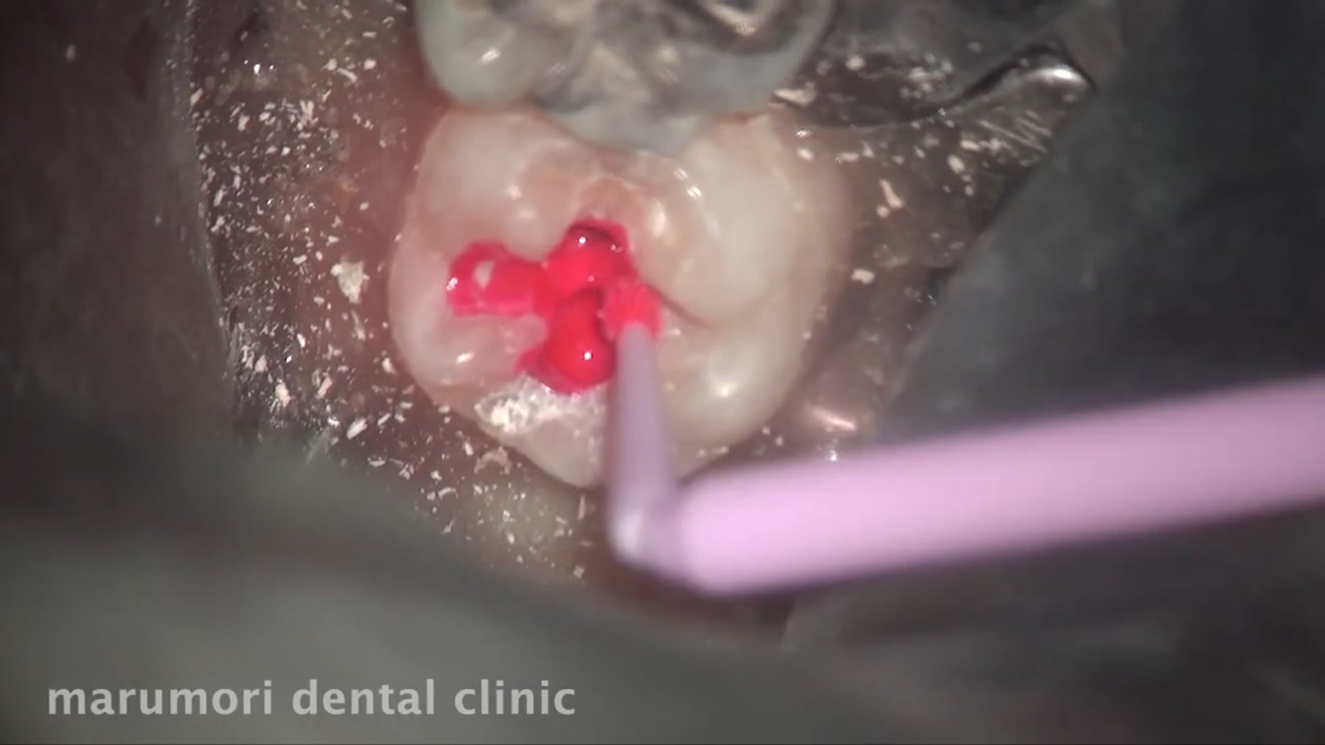 下顎大臼歯・レジン充填