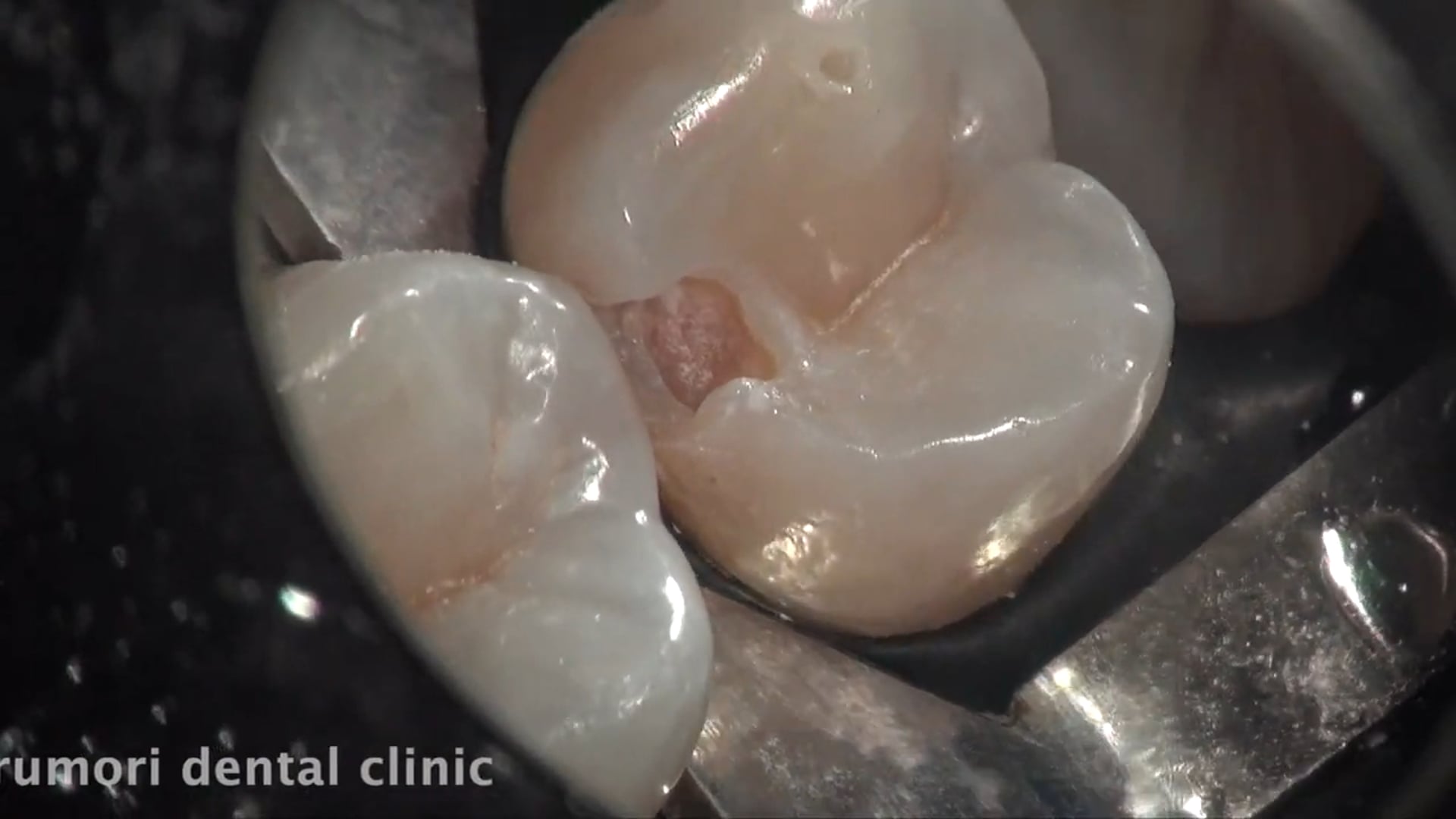 上顎小臼歯・レジン充填