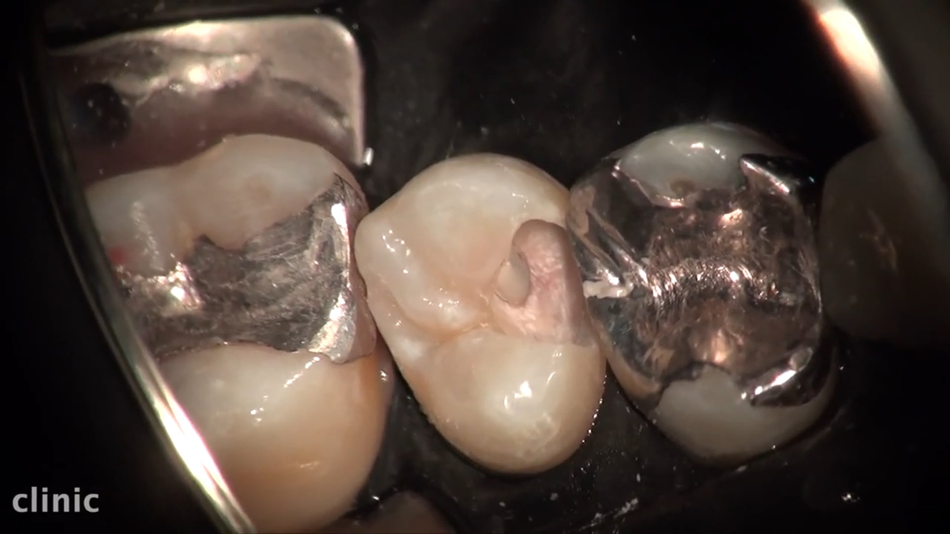 上顎小臼歯・神経保存・レジン充填