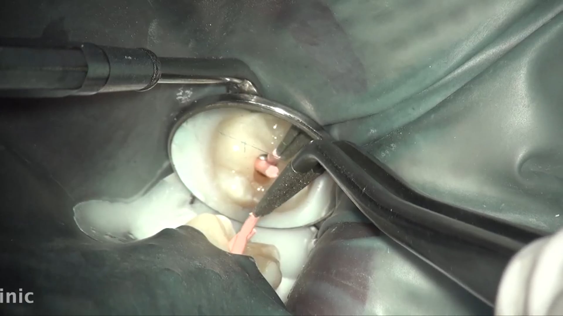 上顎大臼歯・根管治療