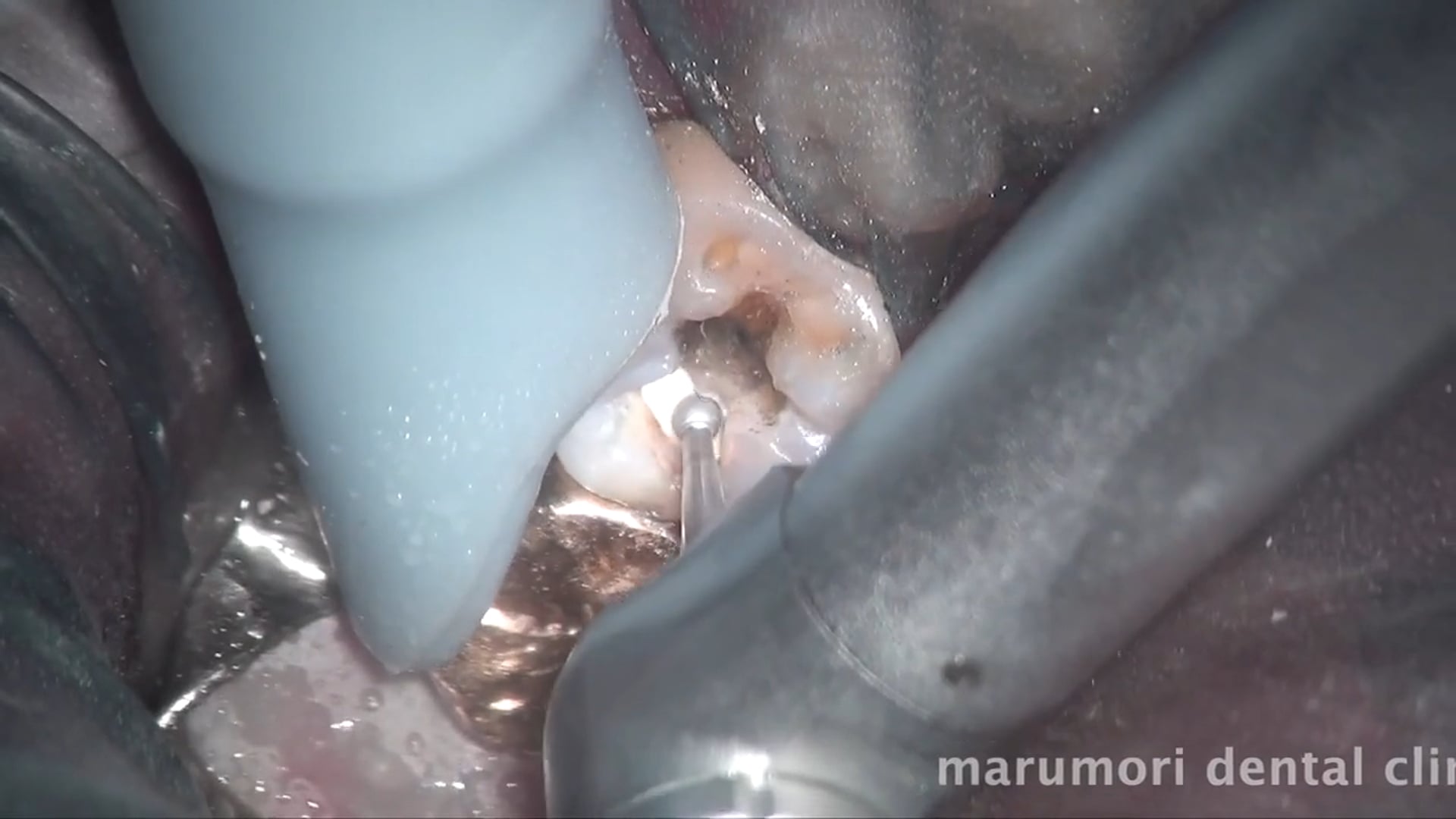 下顎大臼歯・レジン充填