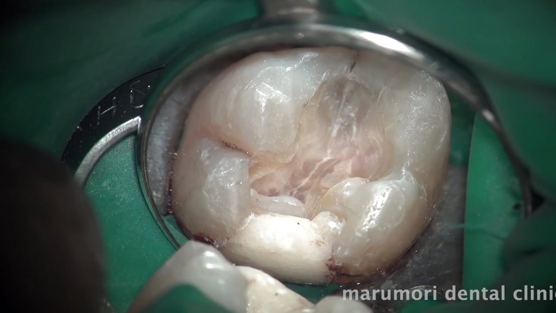 上顎大臼歯・根管治療