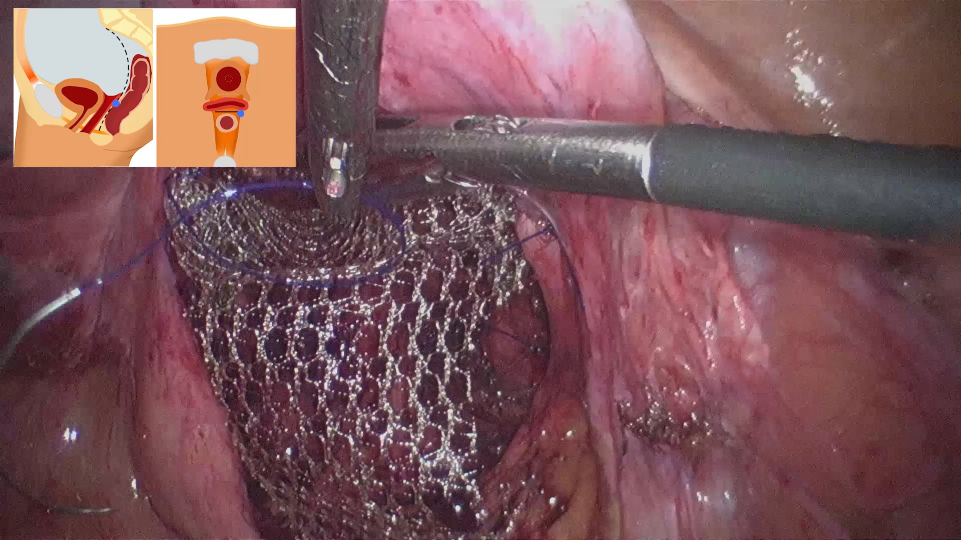 CIRUGÍA LAPAROSCÓPICA - Hospital Ramón y Cajal