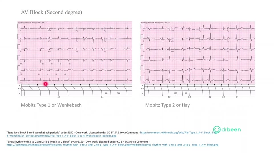 First and Second Degree Heart Blocks
