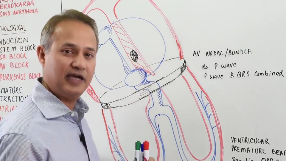 Premature Atrial Beats