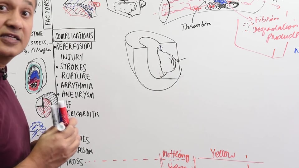 Myocardial Infarction (MI) - Cellular Events and Complications