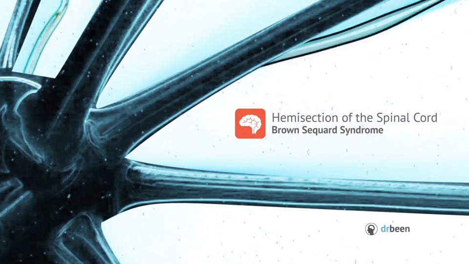 Hemisection of the Spinal Cord