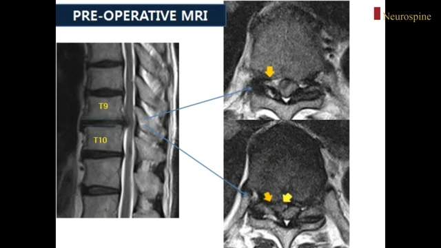 CT-scan of the dorso-lumbar junction showing residual fragmented