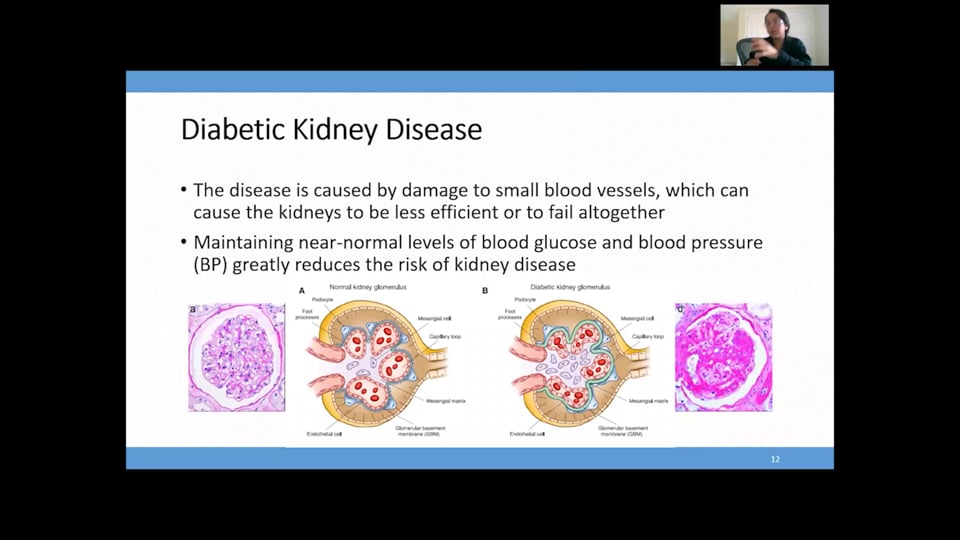 Chronic Kidney Disease (CKD) - Part 2