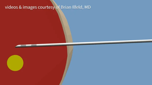 Peripheral Nerve Stimulation Video