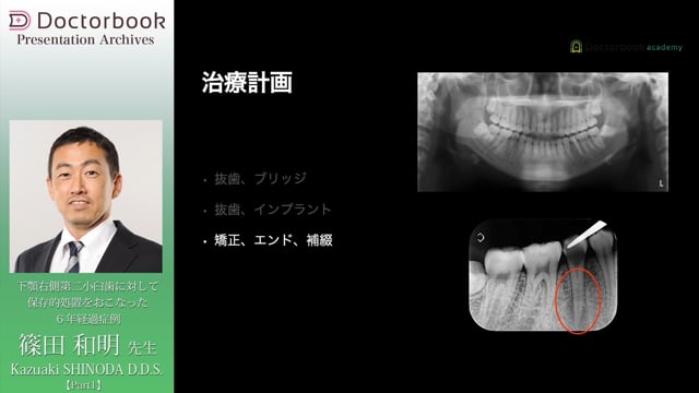 下顎右側第二小臼歯に対して保存的処置をおこなった6年経過症例