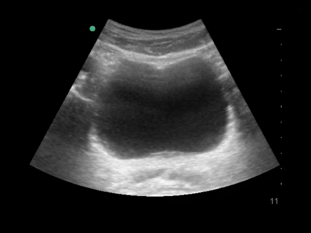 A) A B-mode ultrasound image of a bladder in a transverse section