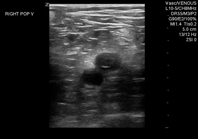 popliteal vein ultrasound
