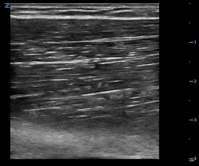 Soft Tissue Ultrasound 