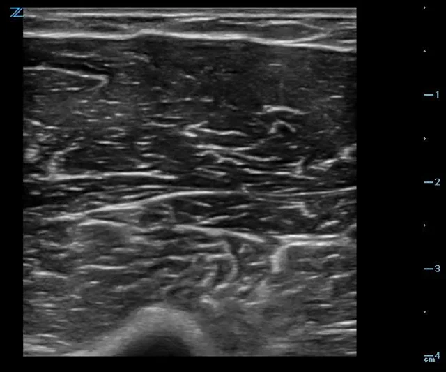 Soft Tissue Ultrasound 
