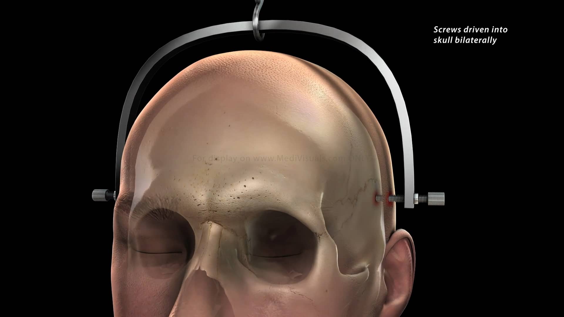 Gardner Wells Tongs Placement And Anterior Cervical Surgeries R29733