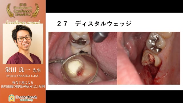 【ケースレポートGP 優秀発表賞】栄田 良一先生「咬合干渉による歯周組織の破壊が疑われた1症例」