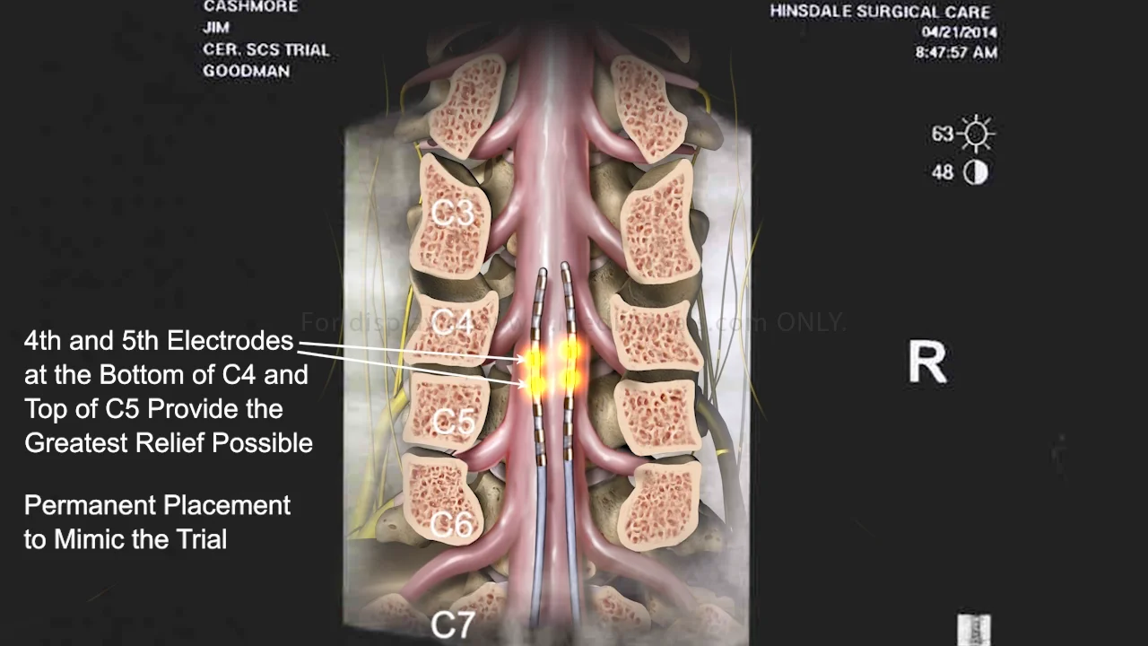 🥇 NYC Spinal Cord Stimulation SCS