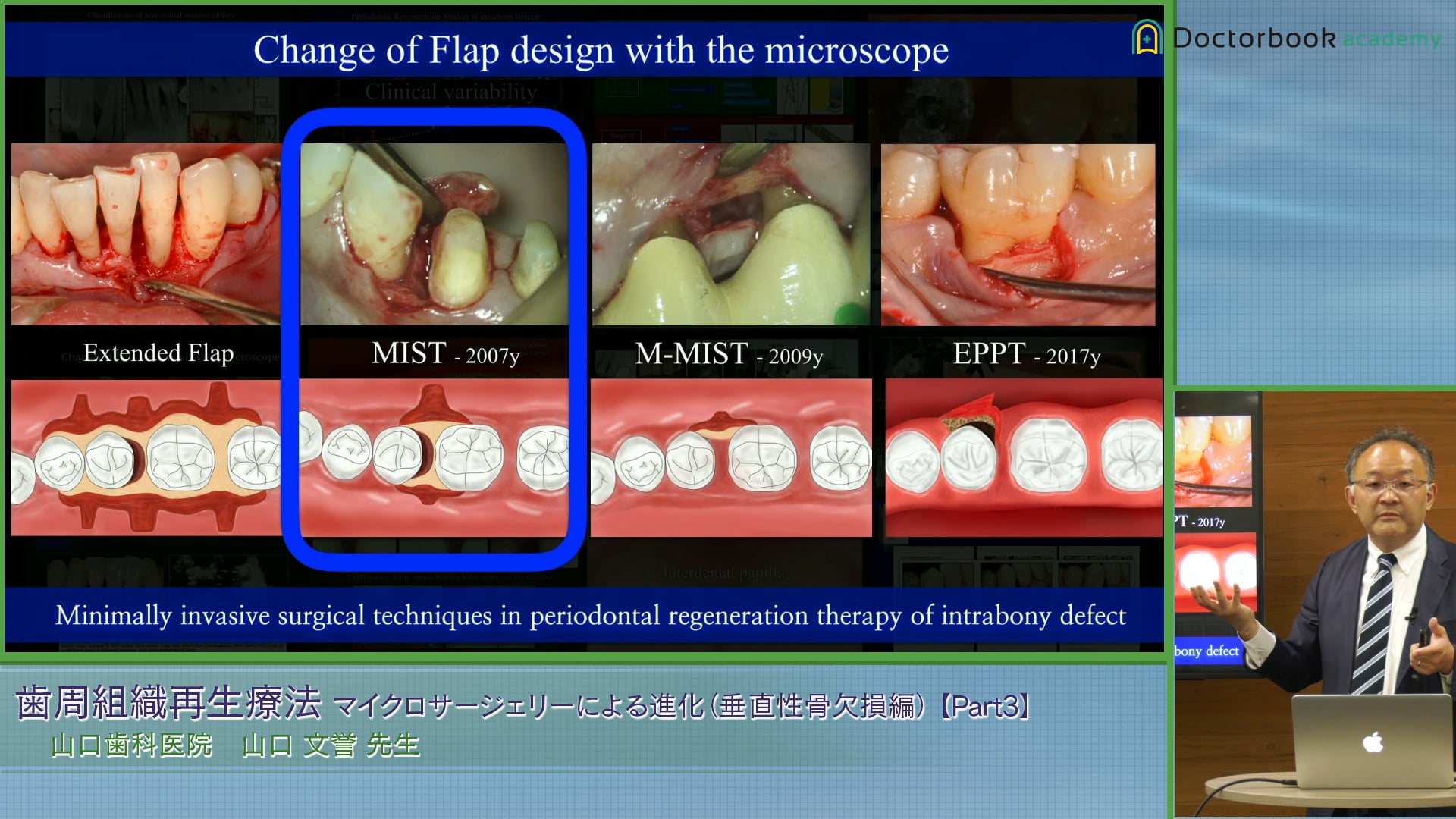 イラスト・写真・動画で学ぶ!低侵襲 歯周組織再生療法 - 健康/医学