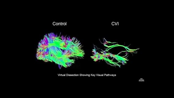 BBC News Reporting Scotland Clip (with Amazing Brain Images From Lab ...