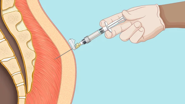 Intramuscular Injection Video