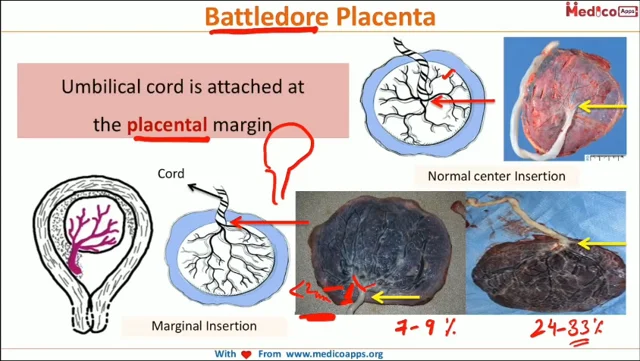 battledore placenta