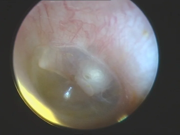 tympanic membrane cholesteatoma