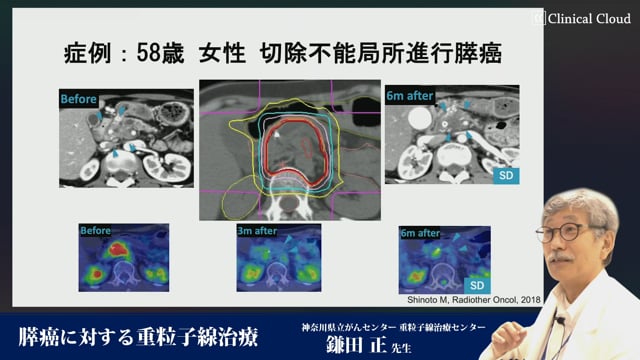 膵癌に対する重粒子線治療 Part2