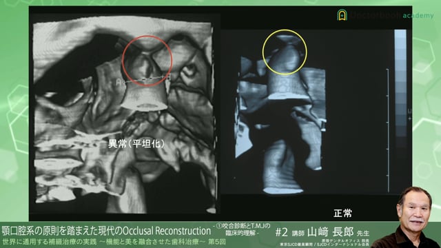 #2 咬合診断とT.M.Jの臨床的理解