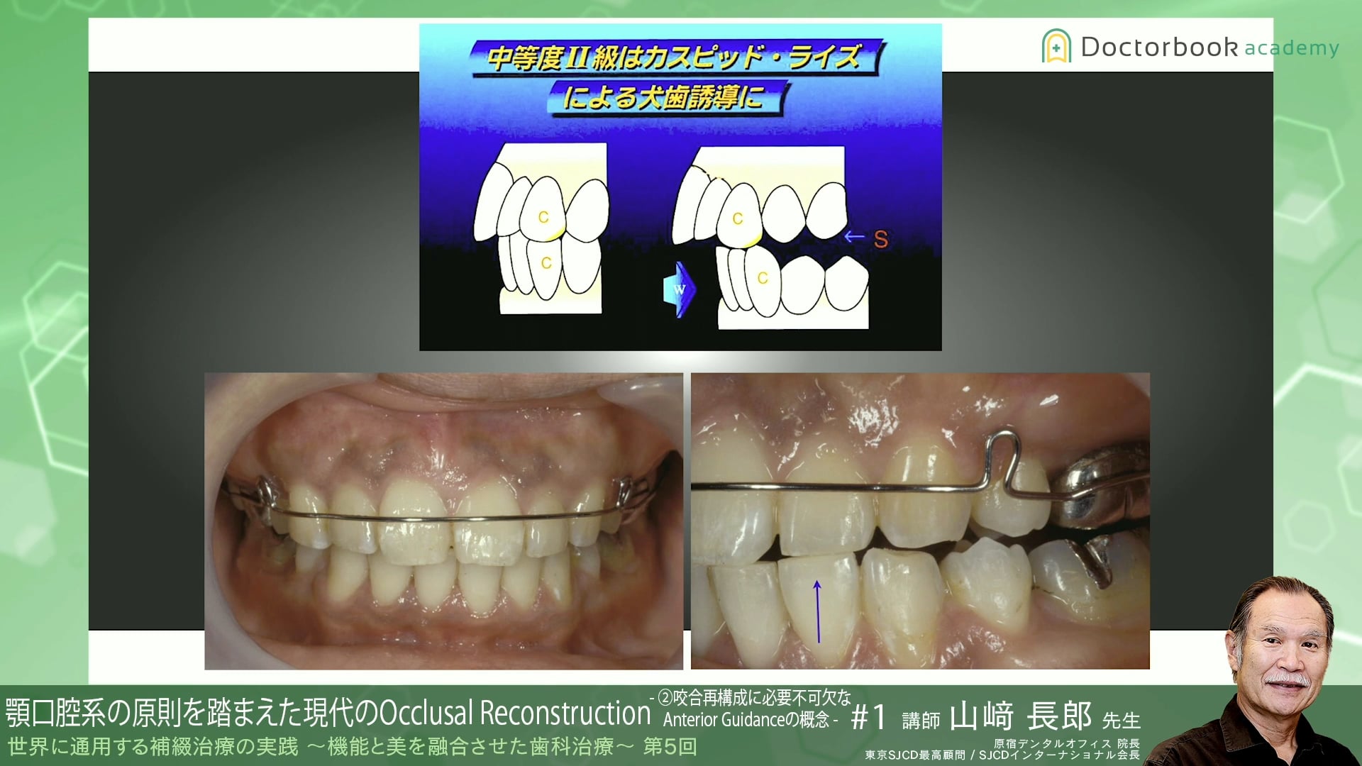 #5 咬合再構成に必要不可欠なAnterior Guidanceの概念