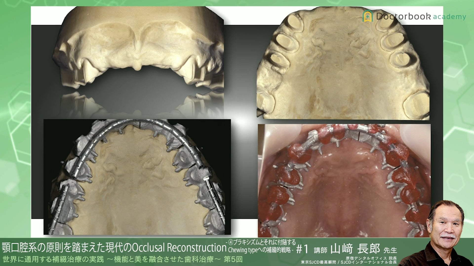 #10 ブラキシズムとそれに付随するChewing typeへの補綴的戦略