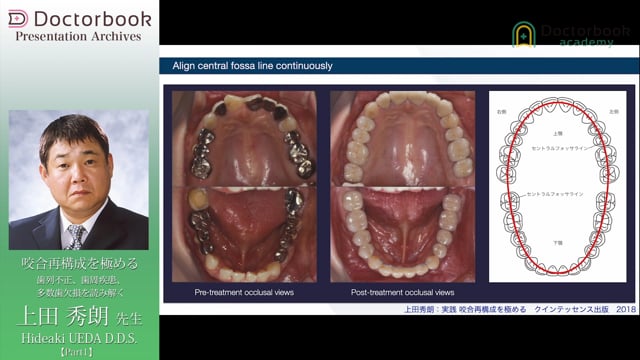 咬合再構成を極める -歯列不正、歯周疾患、多数歯欠損を読み解く 