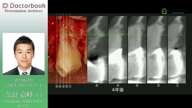 #1 右下４歯周組織再生療法