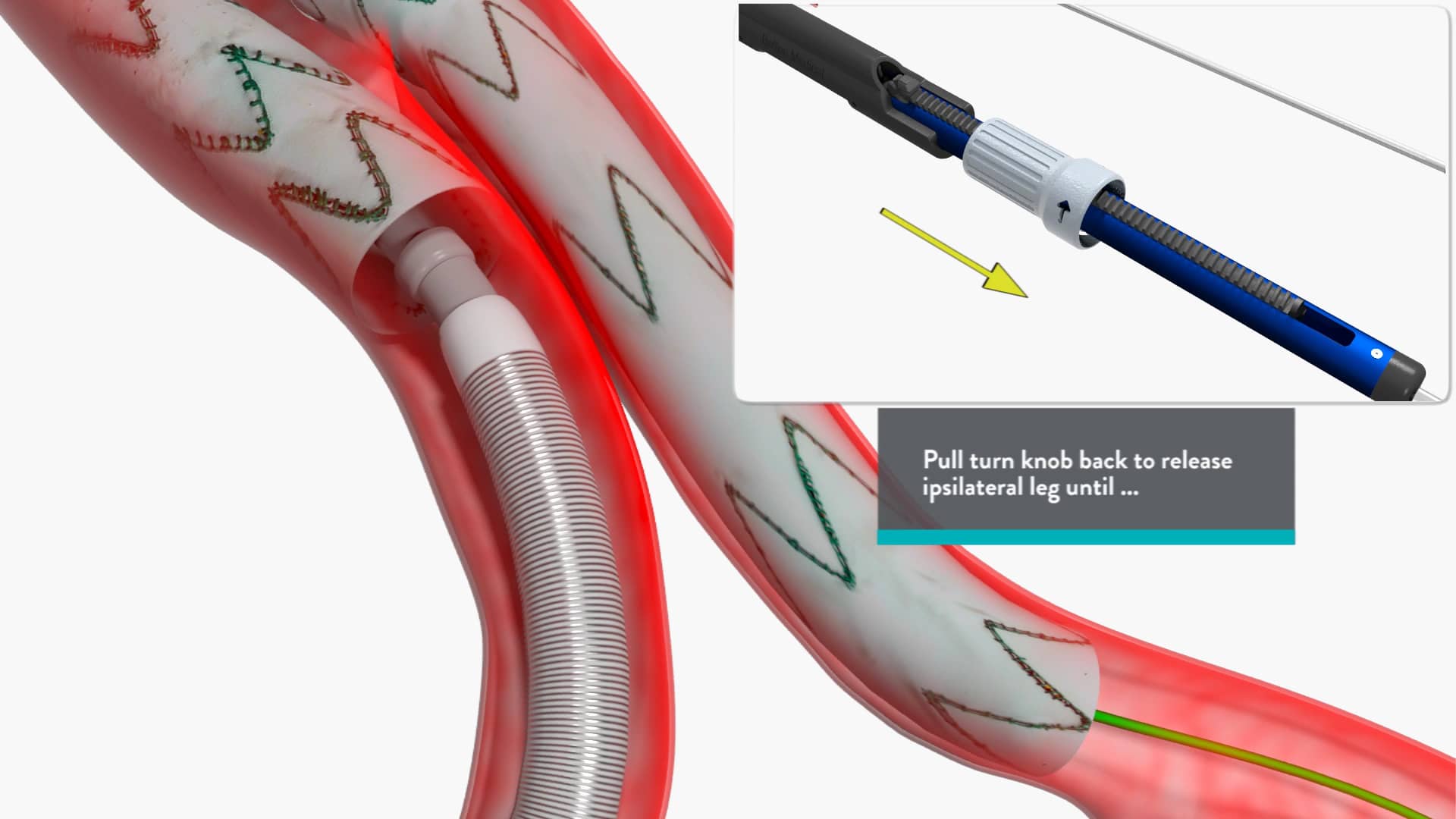 Terumo Aortic Treo Deployment Animation on Vimeo