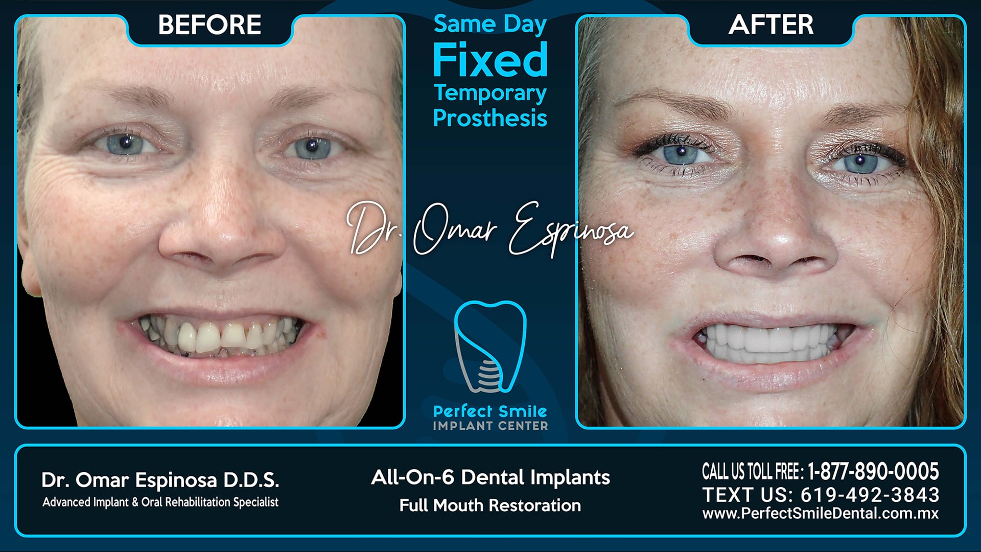All On 6 Dental Implants Top & Bottom - Perfect Smile Implant Center - Tijuana, Mexico