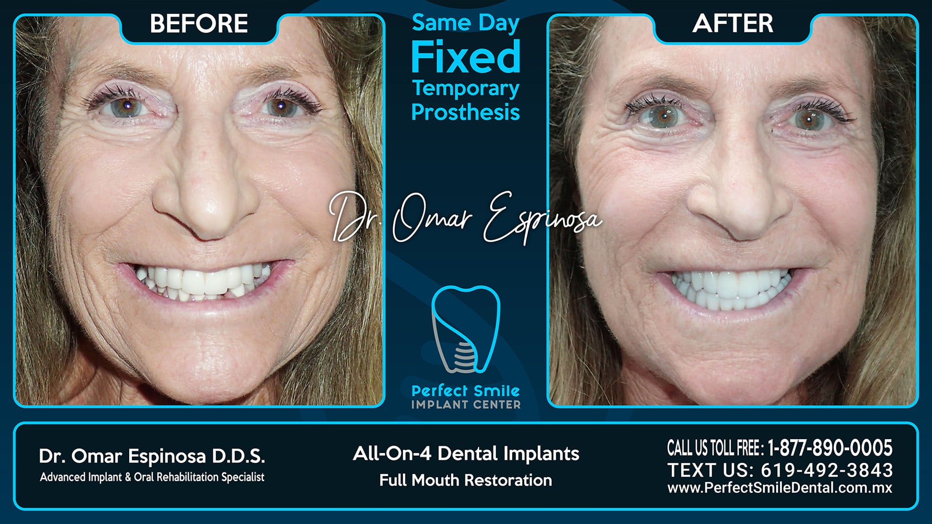 All On 4 Dental Implants Top & Bottom - Perfect Smile Implant Center - Tijuana, Mexico