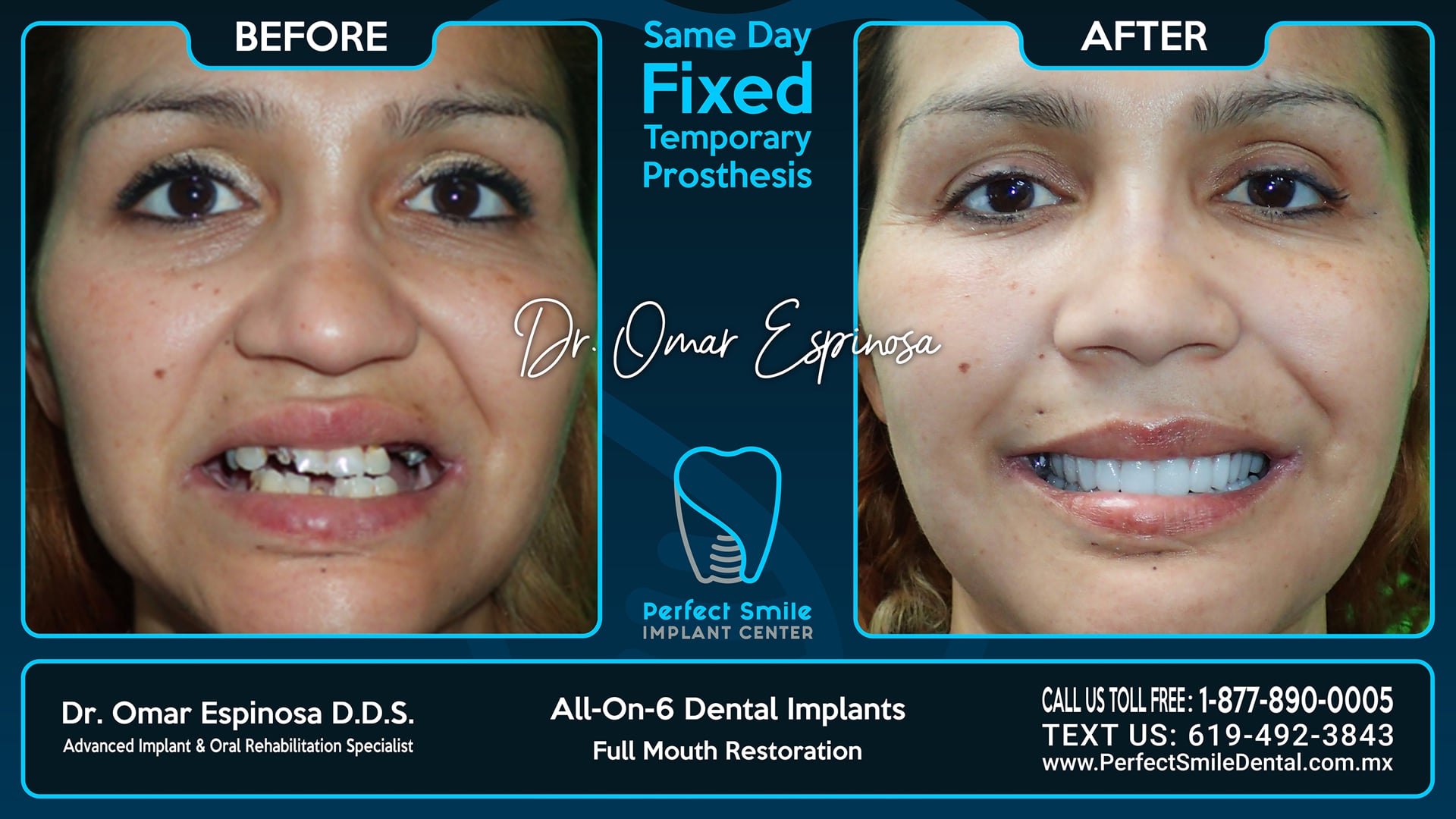 All On 6 Dental Implants Top & Bottom - Perfect Smile Implant Center - Tijuana, Mexico