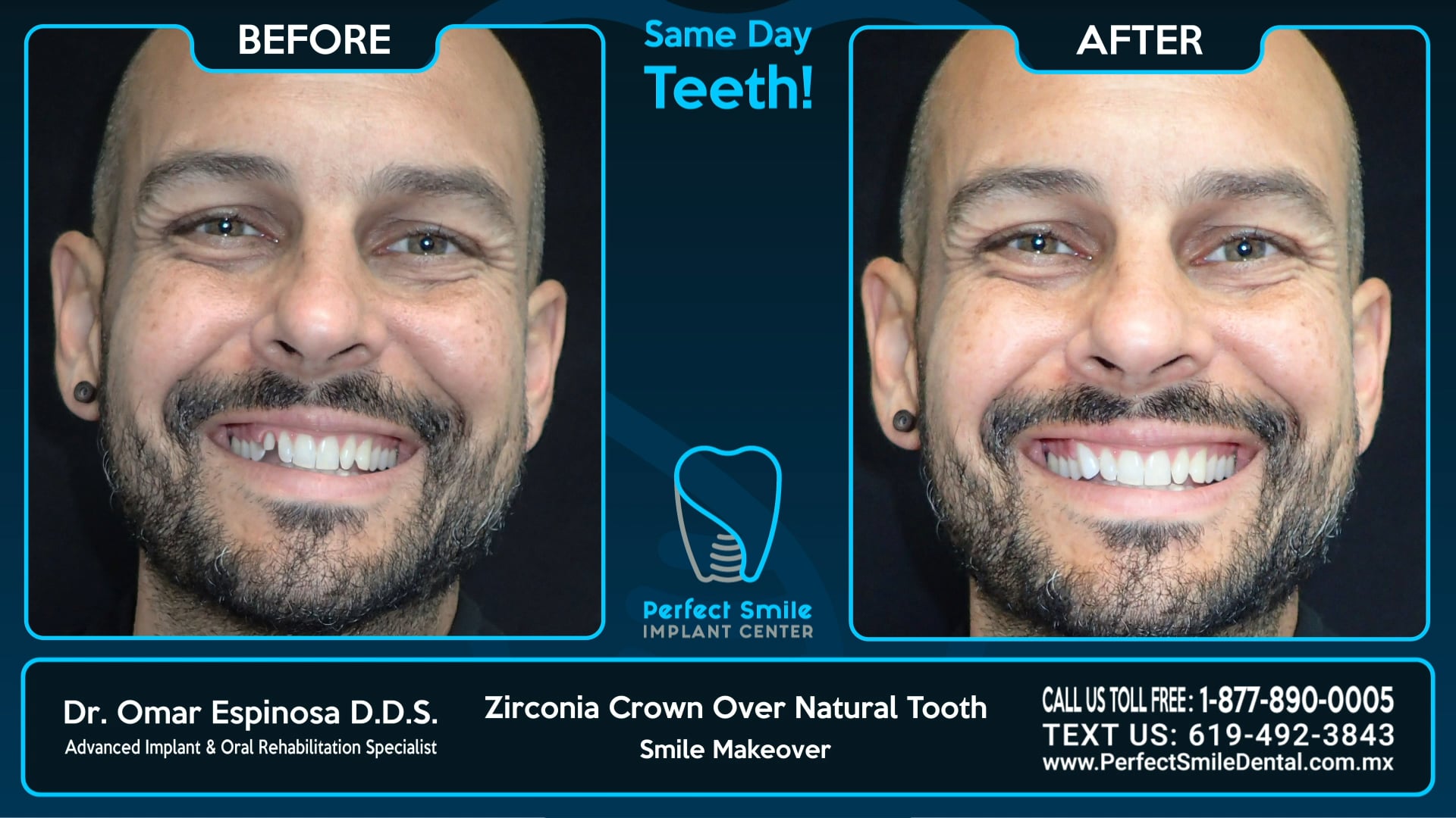 Zirconia Crown Over Natural Tooth - Perfect Smile Implant Center - Tijuana, Mexico
