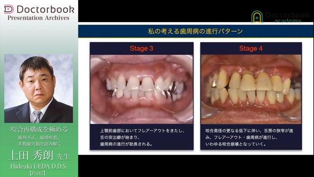 #2 歯周疾患症例の咬合再構成