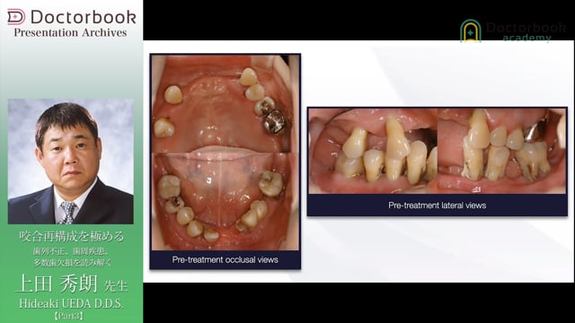 咬合再構成を極める -歯列不正、歯周疾患、多数歯欠損を読み解く 