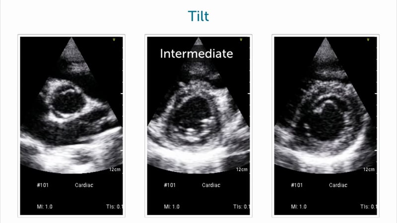 What tips do you have for obtaining good cardiac views?