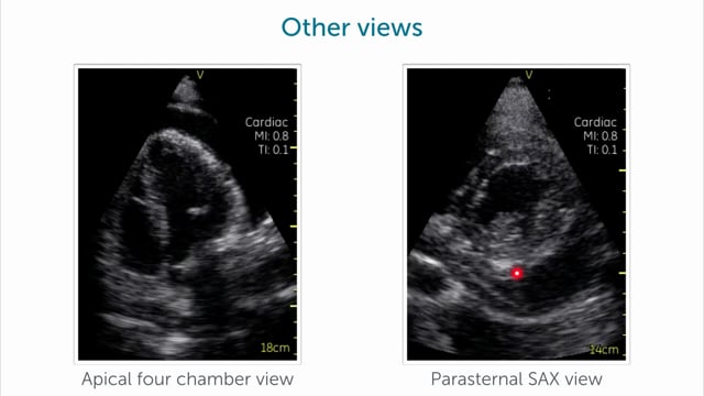 How can I find pericardial effusion in POCUS?