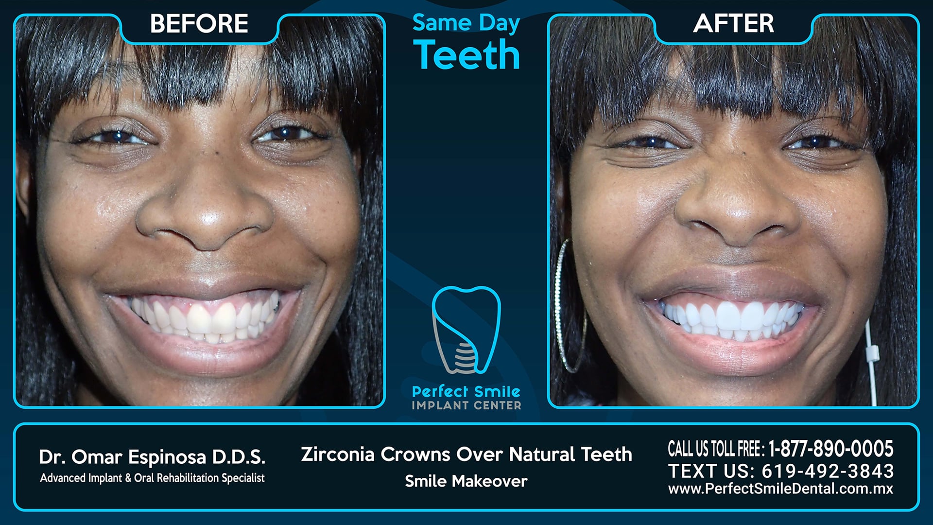 Zirconia Crowns Over Natural Teeth - Perfect Smile Implant Center - Tijuana, Mexico