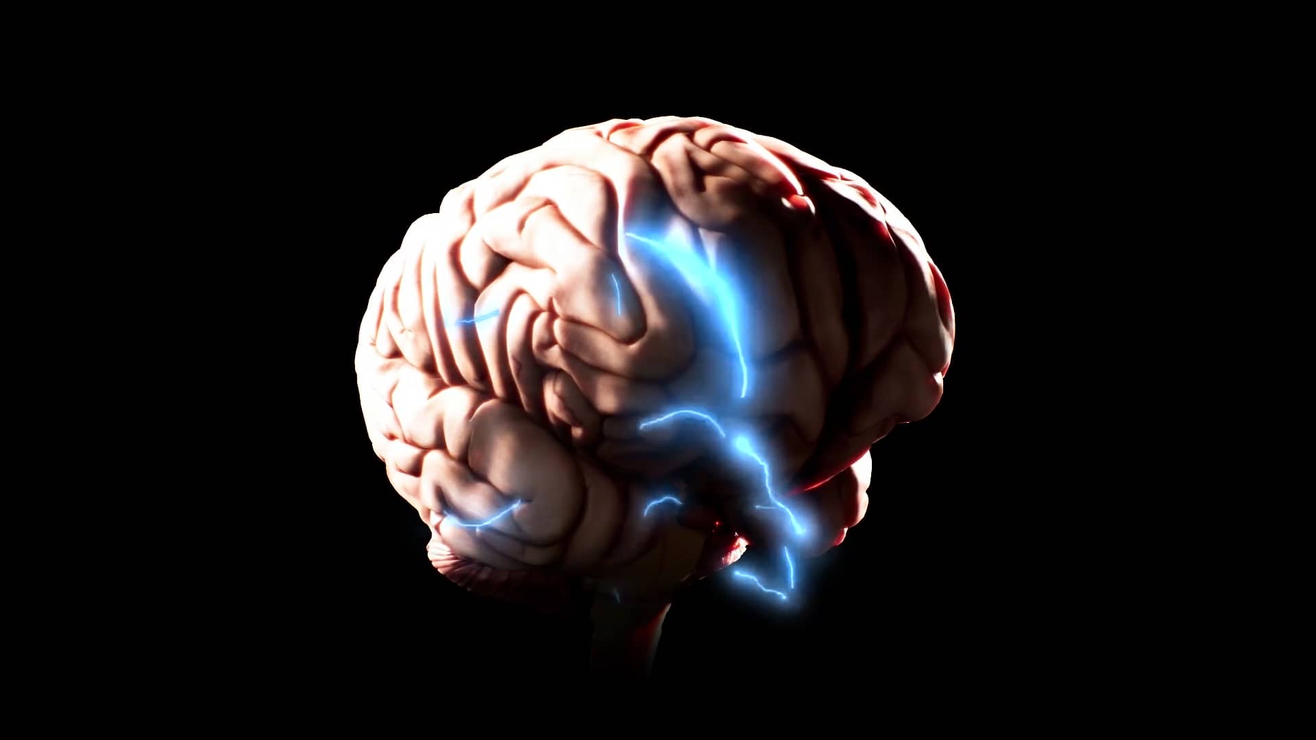 Seizure Management With EEG In The Intensive Care Unit ICU On Vimeo