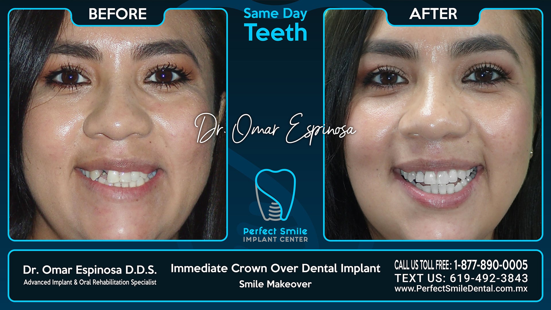 Single Implants - Perfect Smile Implant Center - Tijuana, Mexico