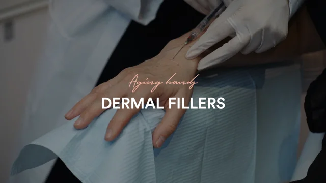 Hyaluronic acid | Dermal fillers | Hand rejuvenation | Clinique Chloé