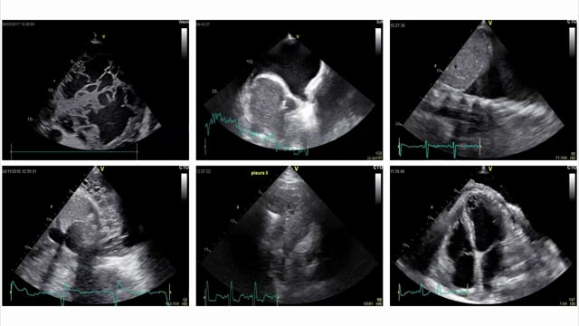 What does a pleural effusion look like in ultrasound?