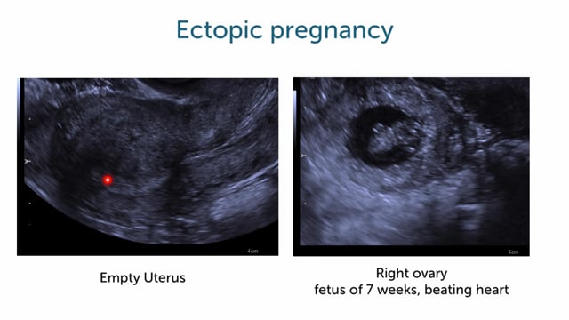 How can I spot extra-uterine gravidity with ultrasound?